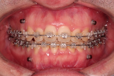부산긴얼굴긴턱교정