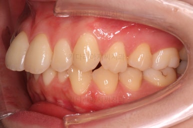 부산돌출입교정