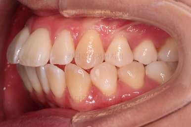 부산치아교정잘하는치과