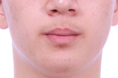 부산청소년치아교정