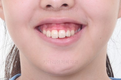 부산투명교정