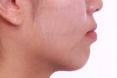 부산연산역치아교정