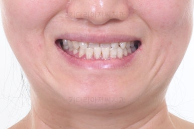 부산치아교정잘하는곳