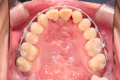 부산구순구개열교정