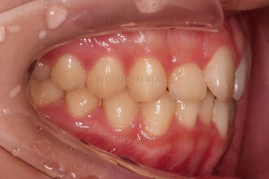 부산비발치교정