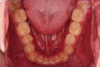 부산주걱턱교정
