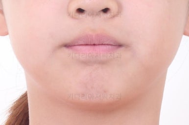 부산토끼치아교정