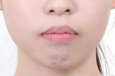 부산클리피씨교정