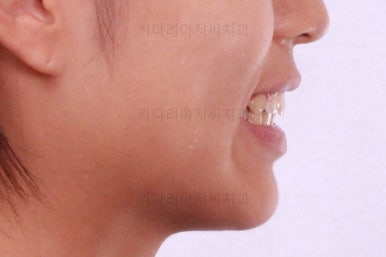 부산연산역치아교정