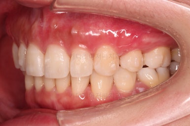 부산인비절라인