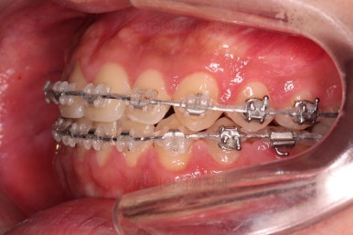 부산주걱턱교정