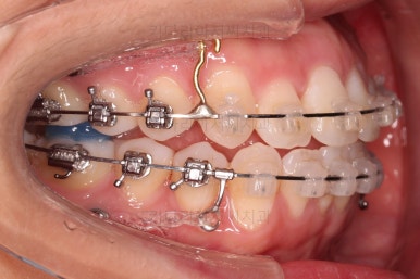 부산교정잘하는치과