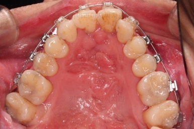 부산구순구개열교정
