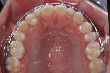 부산왜소치교정