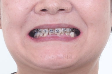 부산옥니교정