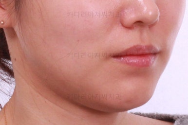 부산치아교정잘하는곳