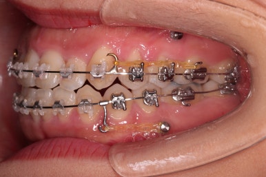 부산비발치교정