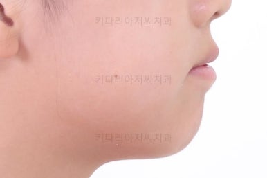 부산토끼치아교정