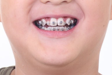 부산비발치교정