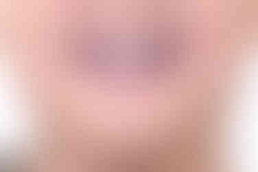 부산비발치교정