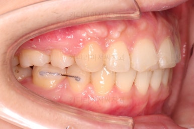 부산연산동교정치과