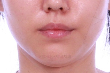 부산치아교정잘하는곳