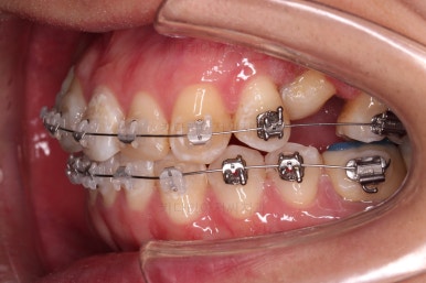 연산동치아교정