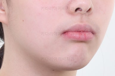 부산투명교정