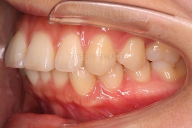 부산연산동교정치과