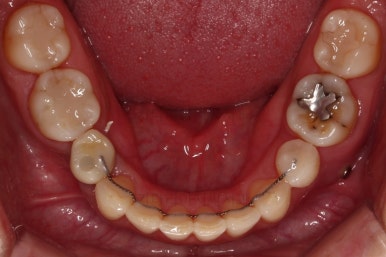 부산인비절라인