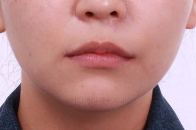 부산사랑니교정