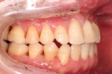 부산구순구개열교정