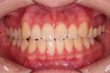 부산치아교정잘하는곳