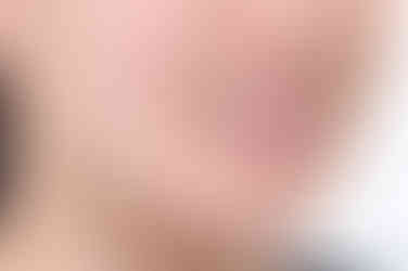 부산비발치교정