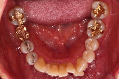 동래임플란트교정