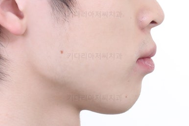 부산돌출입교정