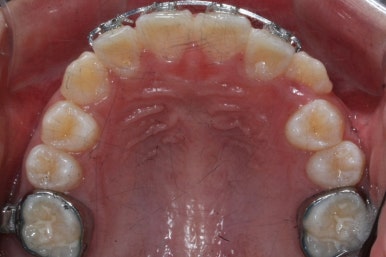 연산동덧니교정