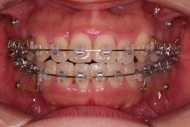 부산비발치교정