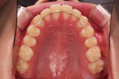 부산주걱턱교정