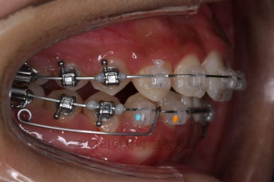 연산동치아교정