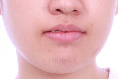 부산비발치교정