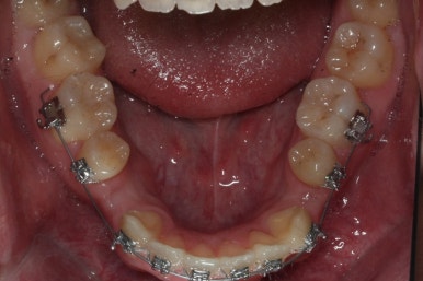 부산구순구개열