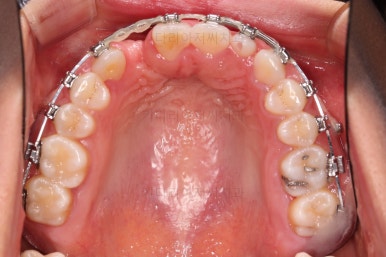 부산구순구개열