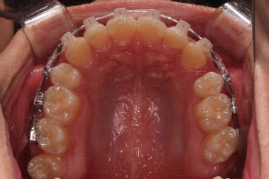 부산청소년치아교정