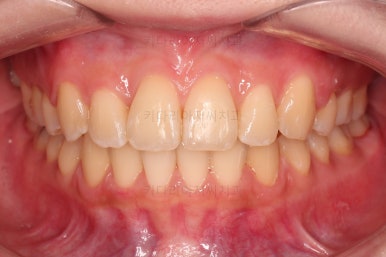 부산돌출입교정