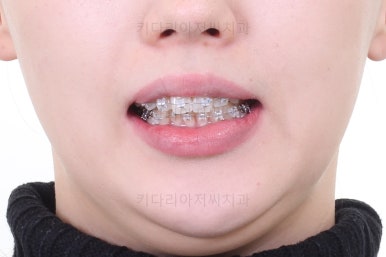 부산비대칭교정