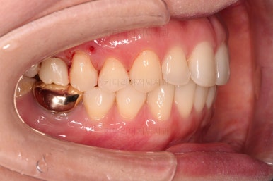 부산치아교정비용