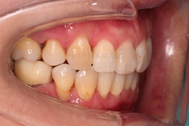 동래임플란트교정