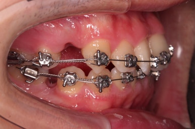 부산교정치과추천