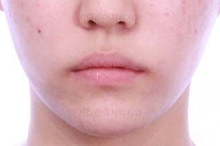 부산비발치교정
